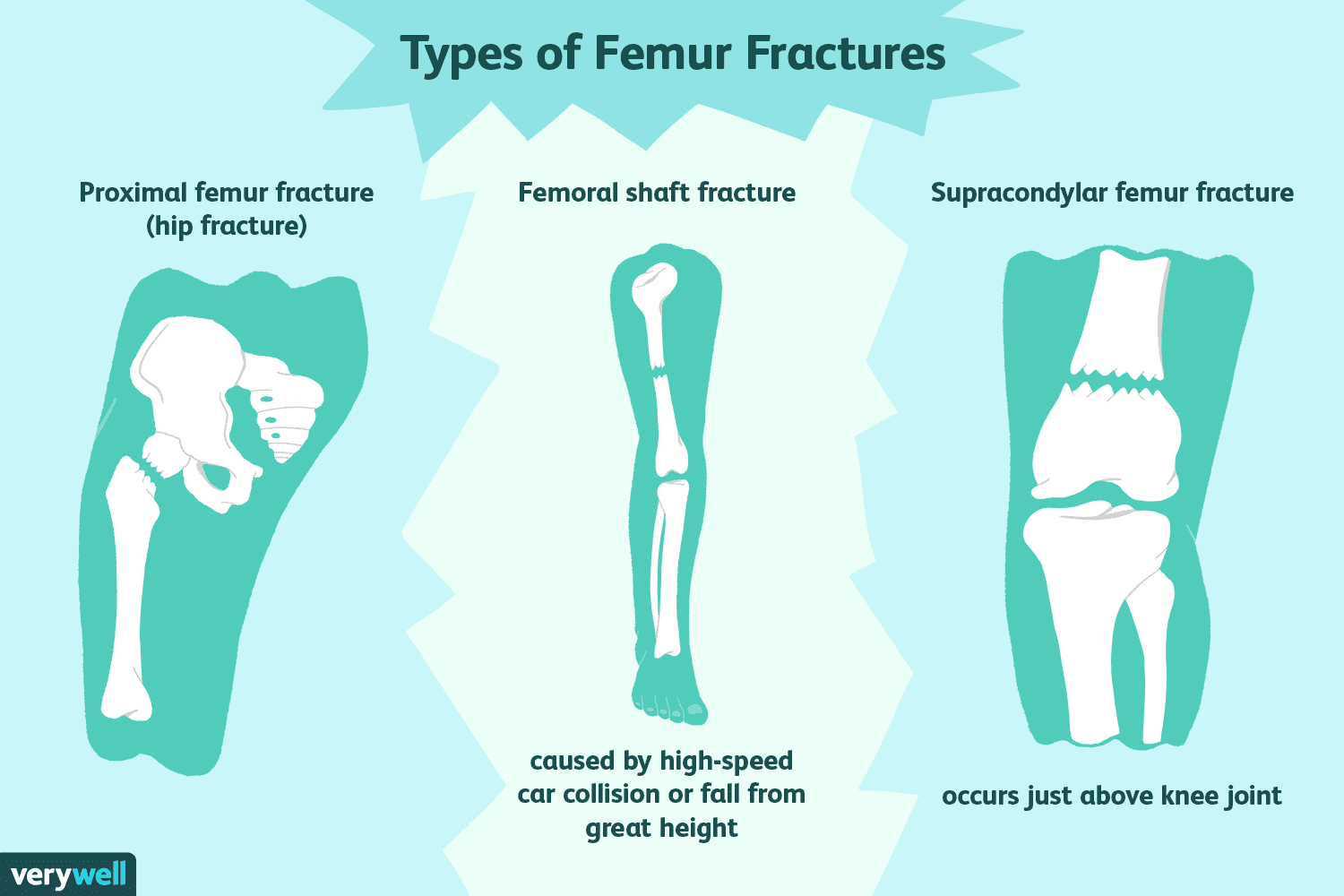 How To Treat A Femur Fracture Broken Thigh Bone How To Treat A Femur Fracture Broken Thigh Bone