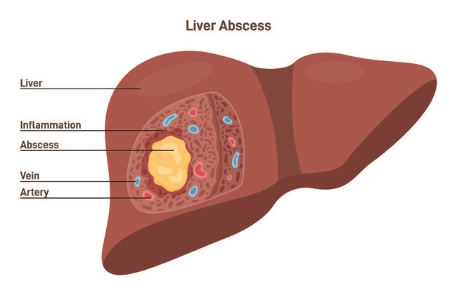 Trombone Abscess: Embroidered Insights & Essential Care Tips