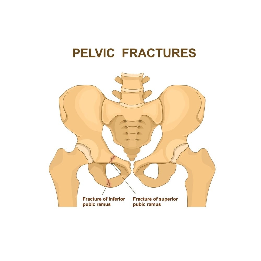 Understand Bone Fractures Causes Treatment Symptoms Zealmax Understand Bone Fractures Causes Treatment Symptoms Zealmax
