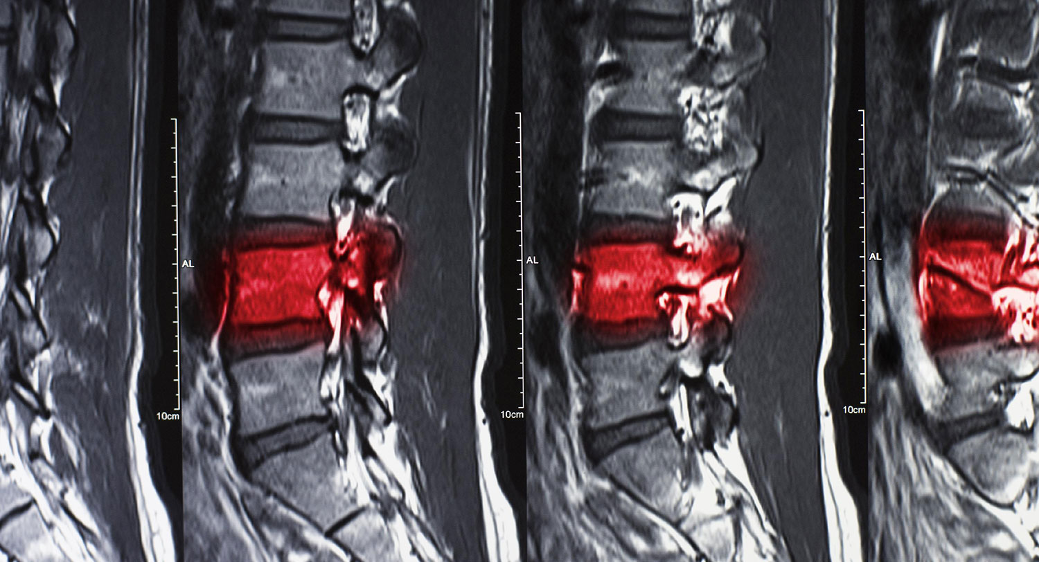 Understanding Spinal Fractures Causes Types And Treatment Atlantic Understanding Spinal Fractures Causes Types And Treatment Atlantic