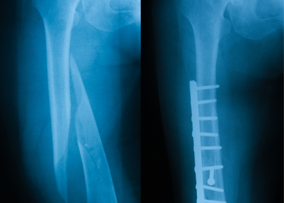 Understanding The Causes And Consequences Of Bone Fractures Understanding The Causes And Consequences Of Bone Fractures